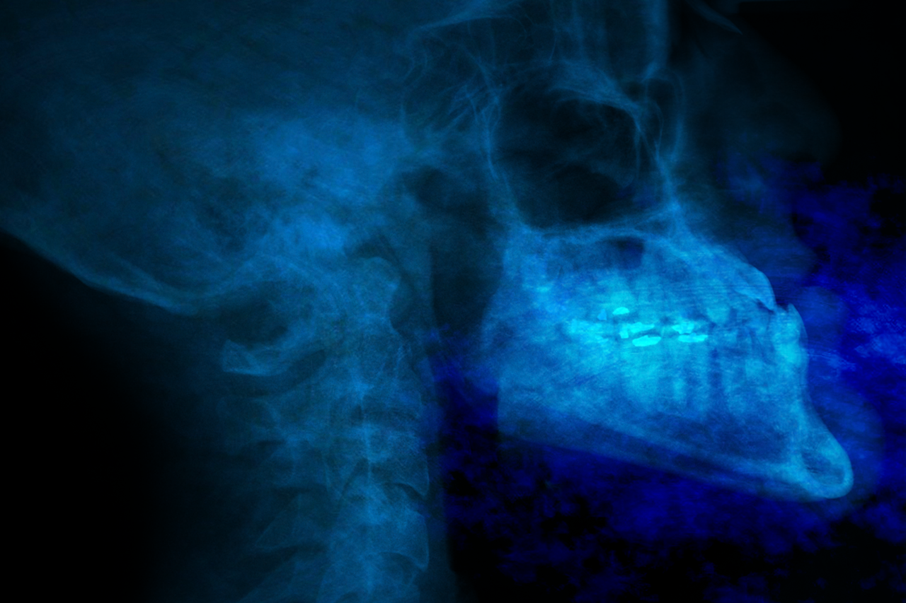 X-ray image of a human lower jaw